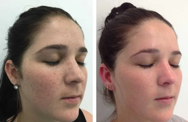 Before and After result C